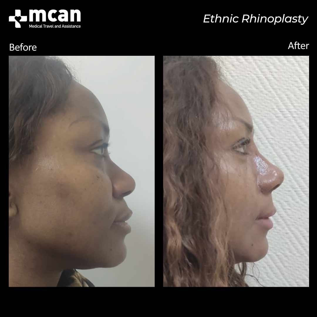 ethnic rhinoplasty2021