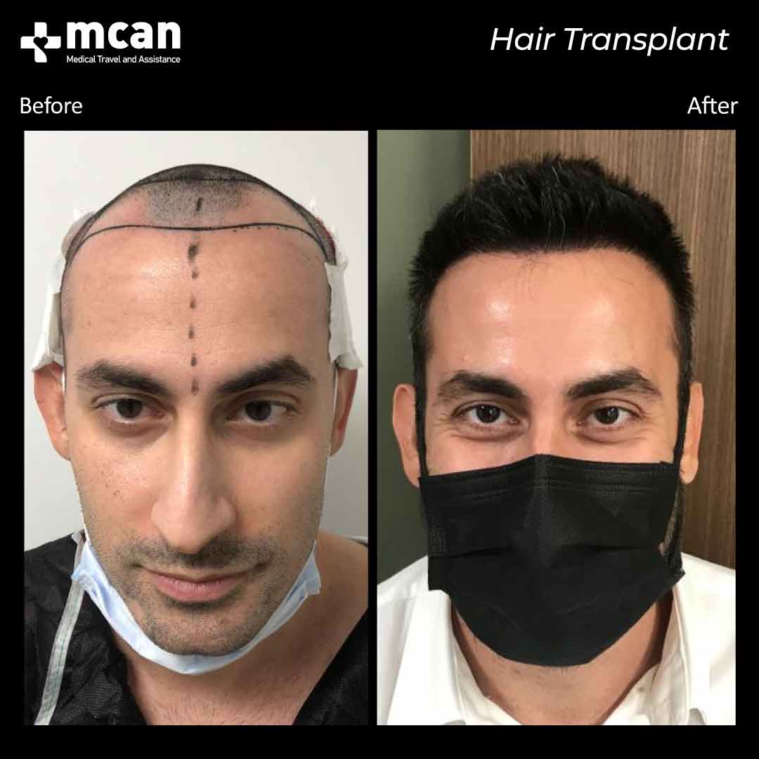 fuat hair transplant
