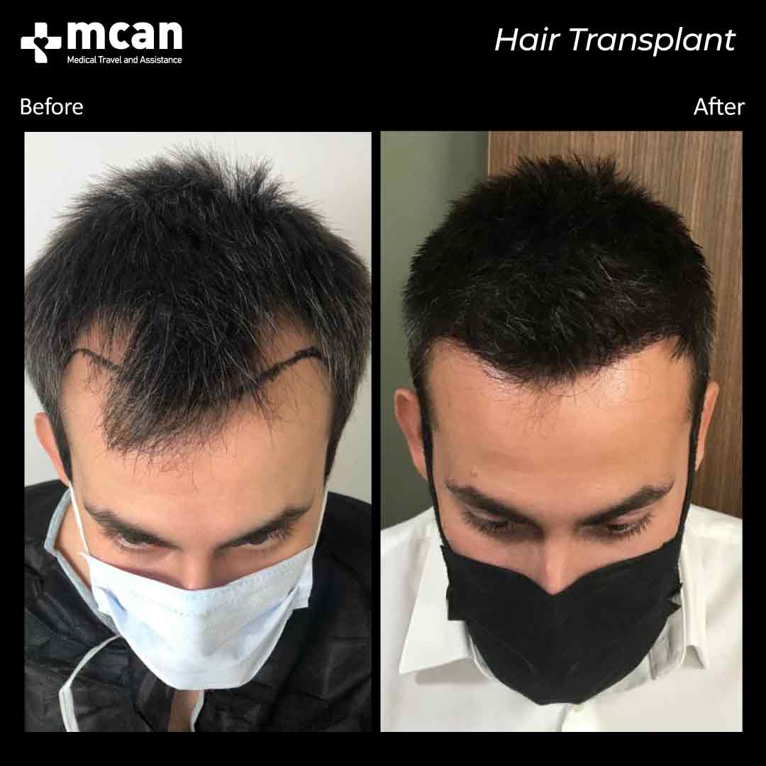 Hair Transplantation Before and After - MCAN Health Hair Transplantation Before and After - MCAN Health