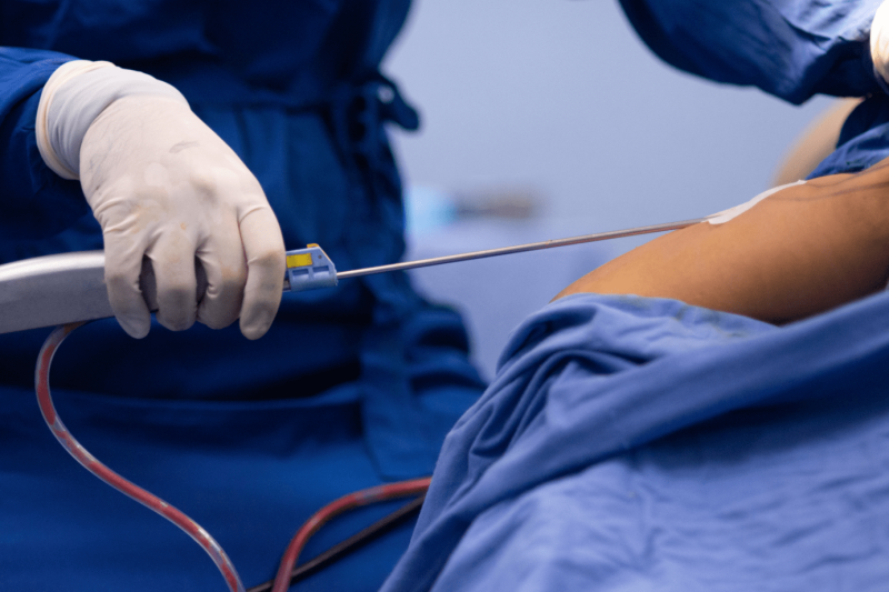 tummy tuck and lipo tummy tuck and lipo