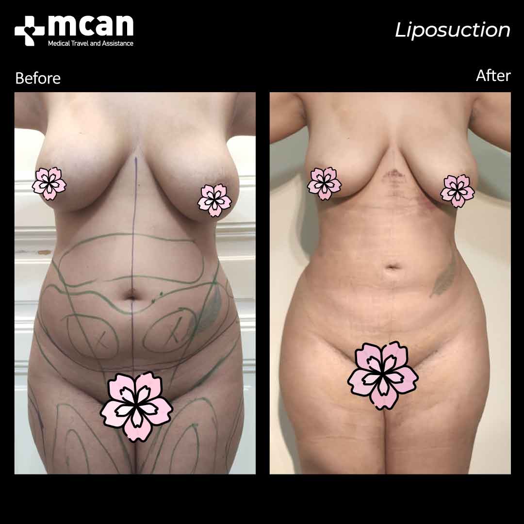 liposuction b a