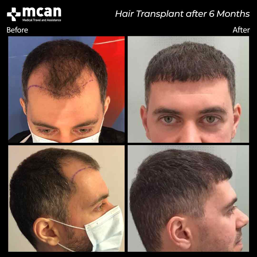 Hair Transplantation Before and After - MCAN Health