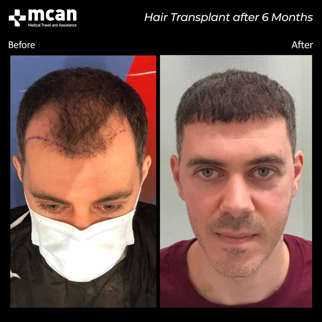 zaal hair transplant2