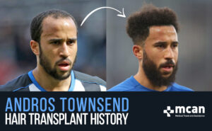 Andros Townsend Hair Transplant analysis | MCAN Health Turkey