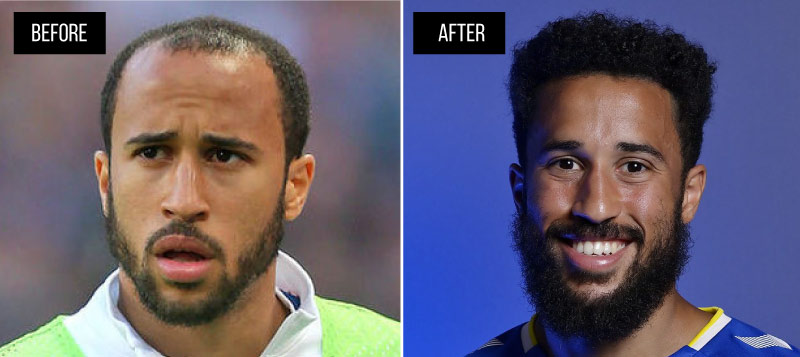 Before and After Andros Townsend Hair Transplant | MCAN Health Turkey