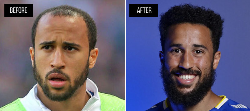 Andros Townsend Hair Transplant Before and After Before and After Andros Townsend Hair Transplant