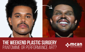 The weeknd Plastic surgery