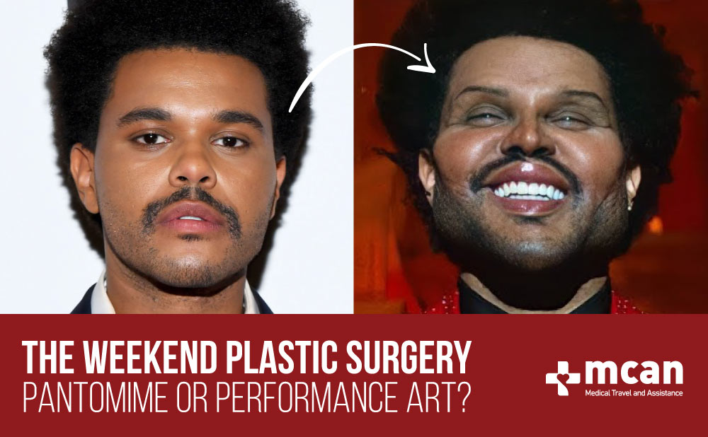 Did the Weeknd Get Plastic Surgery? Unveiling the Transformative ...