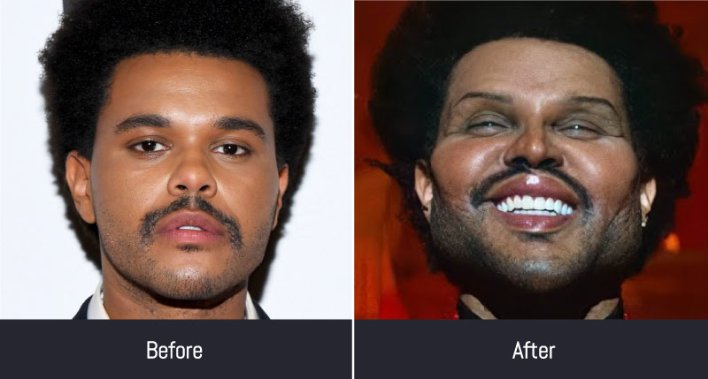 The Weeknd before and after plastic surgery