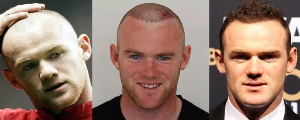Trasplante de cabello de Wayne Rooney