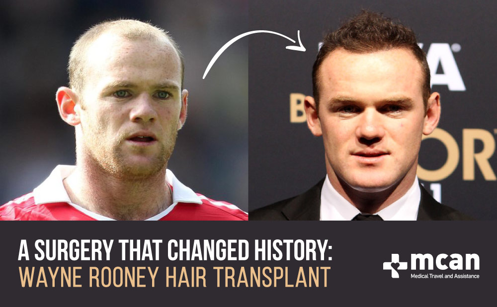 Wayne Rooney Hair Transplant Before and After