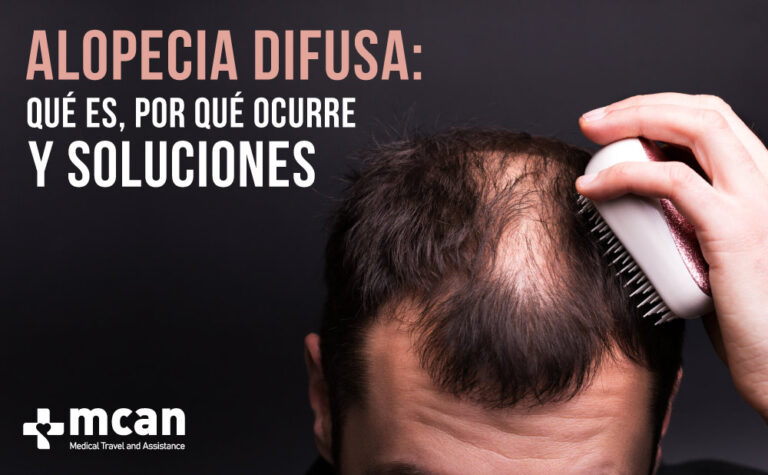 Alopecia difusa: qué es, por qué ocurre y soluciones 9 Alopecia difusa cover Todo sobre la alopecia difusa | MCAN Health Blog