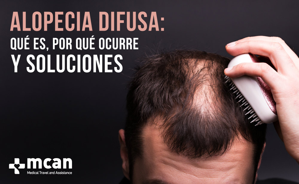 Todo sobre la alopecia difusa | MCAN Health Blog