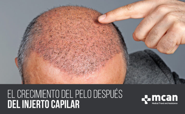 El Crecimiento del Pelo después del Injerto Capilar 10 El crecimiento blog cover El crecimiento del pelo después del injerto capilar | MCAN Health