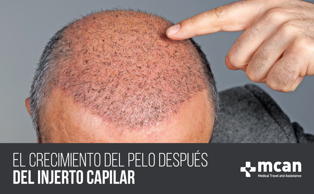 El crecimiento del pelo después del injerto capilar | MCAN Health