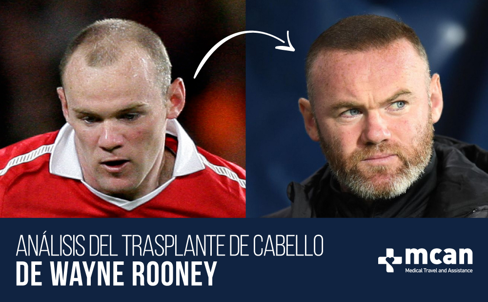 Trasplante de cabello de Wayne Rooney | Análisis de su evolución | MCAN Health
