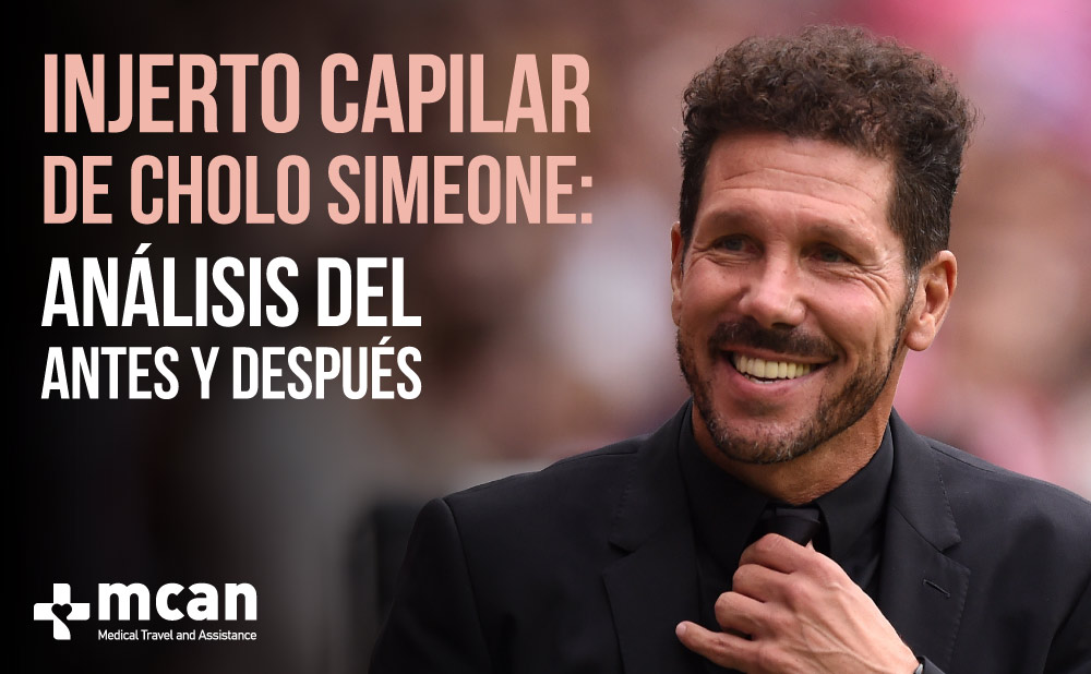 Análisis del antes y después del pelo de Cholo Simeone | MCAN Health Blog