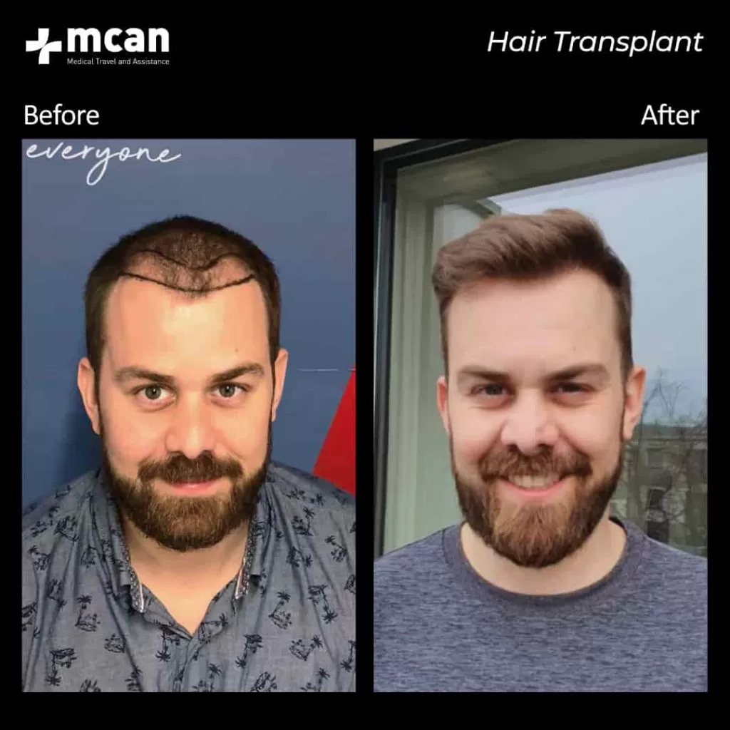 Hair transplant Turkey - costs and experiences - The TV report - YouTube