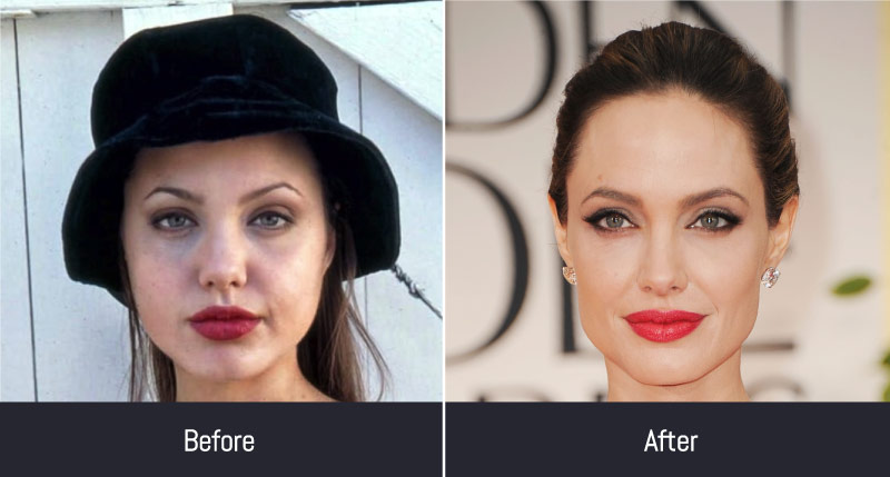 Angelina Jolie Before and After Plastic Surgery 