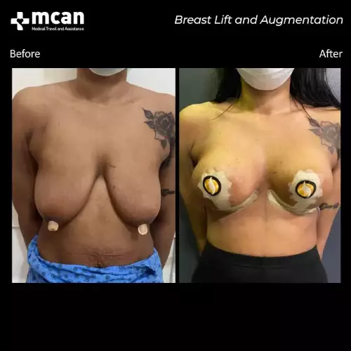 Breast lift Turkey Before After with Mcan Health