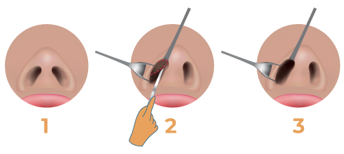 closed rhinoplasty surgery
