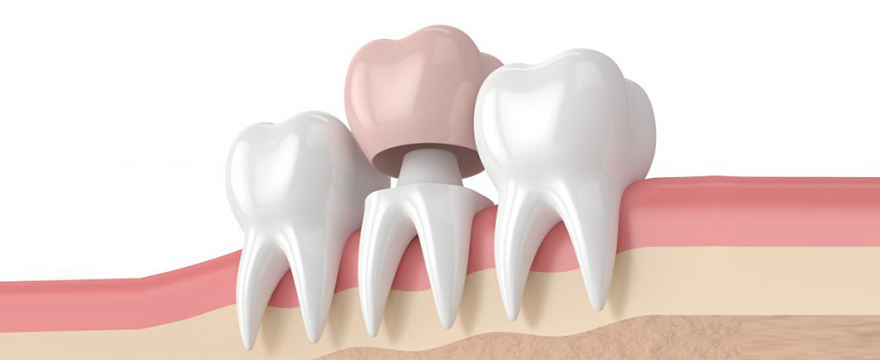 Зубные коронки (стоматологические коронки) в Турции