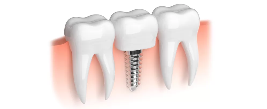 Зубные импланты (имплантация зубов) в Турции