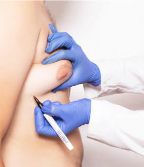 Male Breast Reduction: Gynecomastia Surgery Turkey
