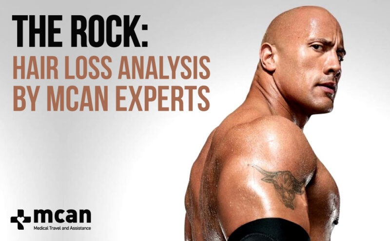 The Rock With Hair: Will Dwayne Johnson Ever Get His Hair Back?
