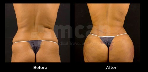 before after turkey liposuction