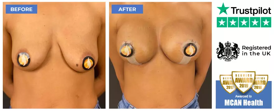 До и после подтяжки груди в Mcan Health