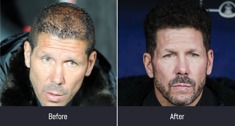 Cholo Simeone: pelo antes y después del implante de cabello | MCAN Health Blog