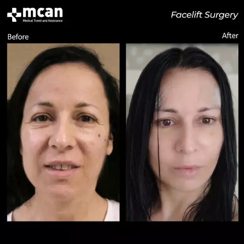 Face Lift Turkey Before and After