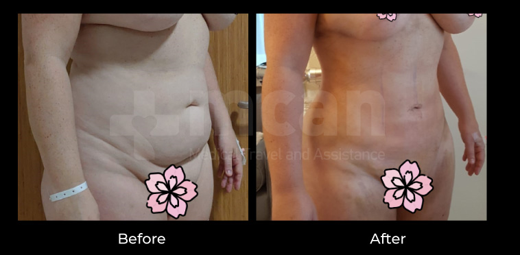 lipo turkey before after