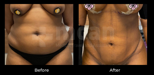 liposuction turkey before after