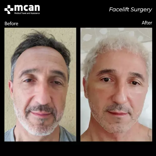 men facelift turkey before after