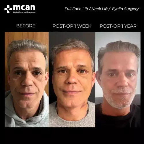 Men Face Lift Turkey Before and After