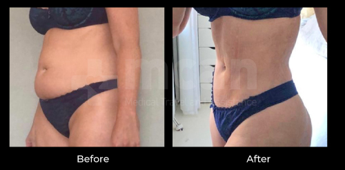 turkey liposuction before after