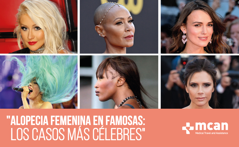 Alopecia femenina en famosas