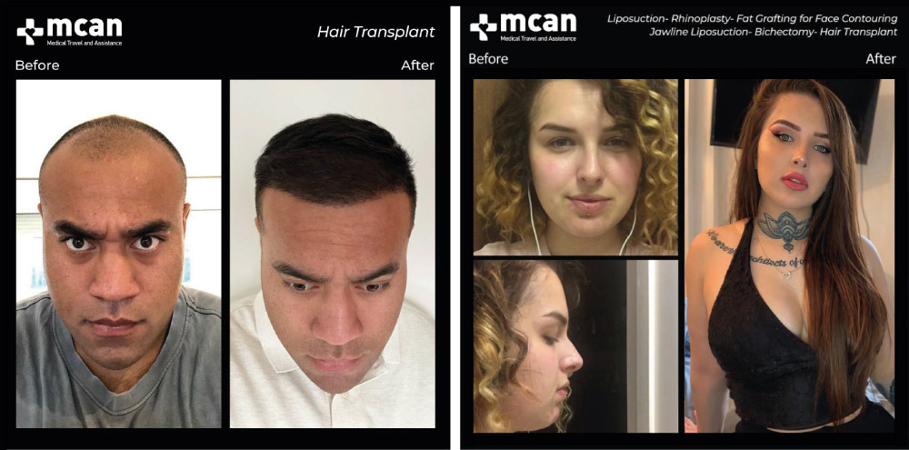 Medical Journey in Turkey with MCAN Health 7 Before After Photos mcan health Before After Photos mcan health