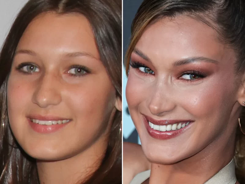 Bella Hadid antes y después de sus operaciones 3 Bella Hadid Antes y Despues e1651137143570 Bella Hadid antes y después de adolescente y modelo