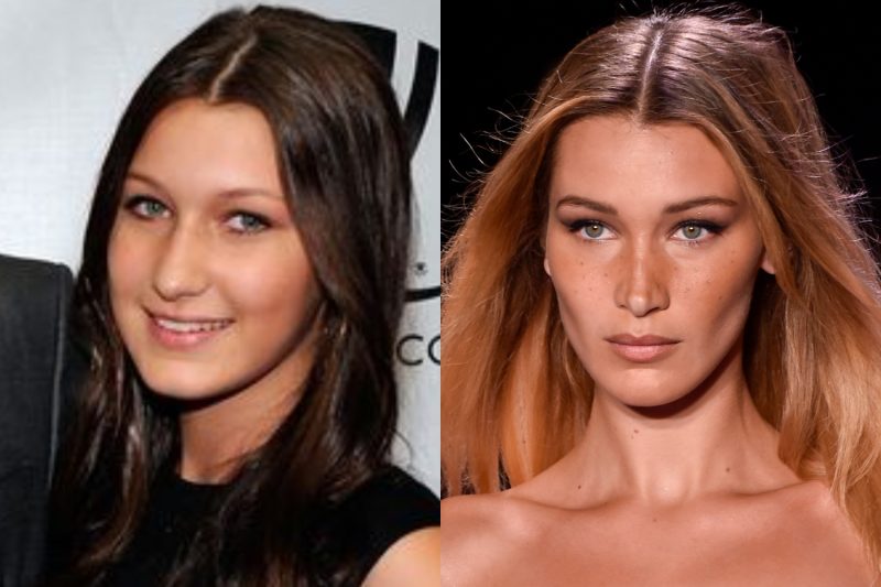 Bella Hadid antes y después de sus operaciones 8 Bella Hadid Bichectomia e1651138095976 Bella Hadid tras una posible bichectomía