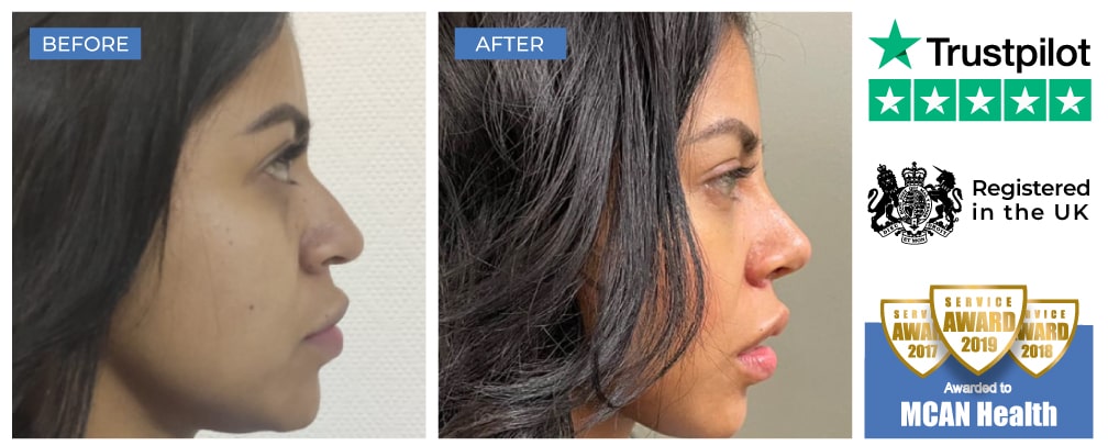 Rhinoplasty Before and After