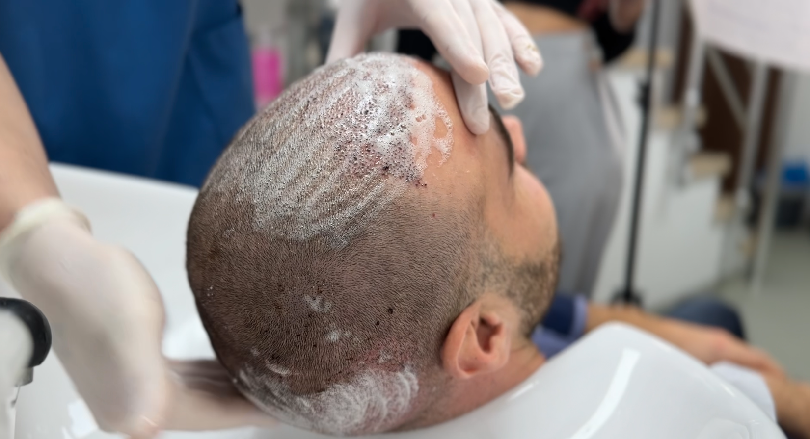 The 10 days instructions for hair wash after hair transplant