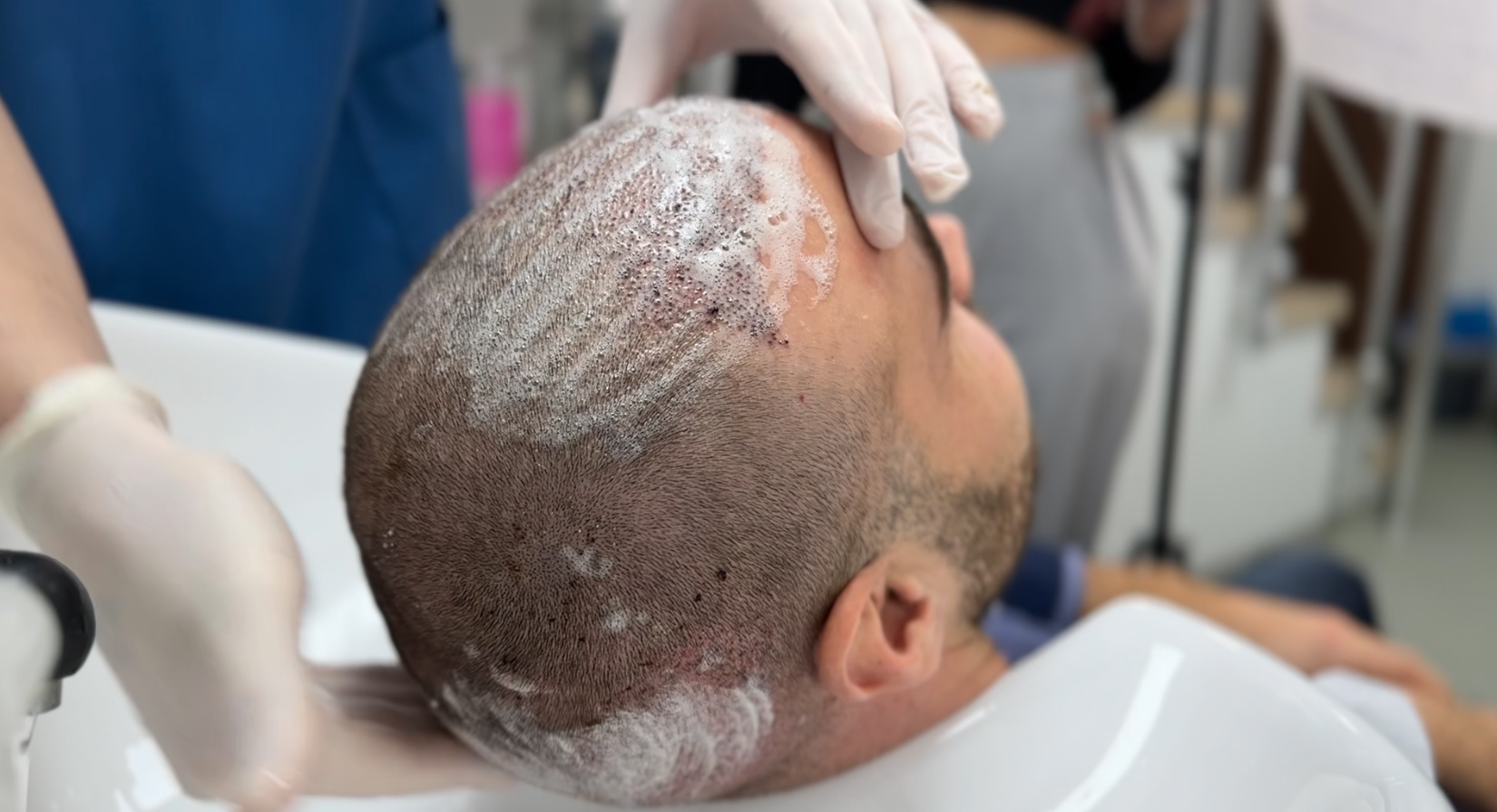 Hair wash after hair transplant