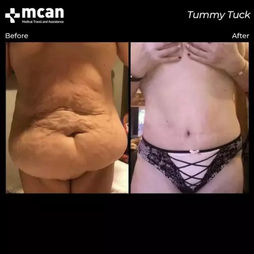 Tummy Tuck Before & After Turkey