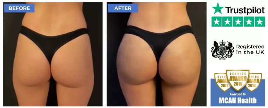 BBL Turkey before and after with MCAN Health