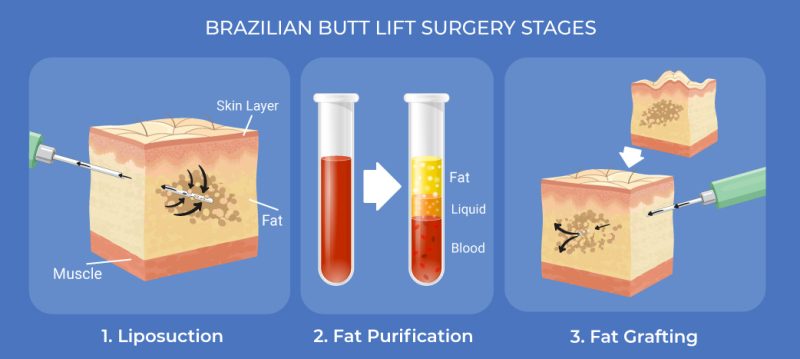 Bbl surgery stages: liposuction, fat purification, fat grafting 