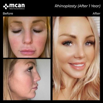 Rhinoplasty surgery before and after 6