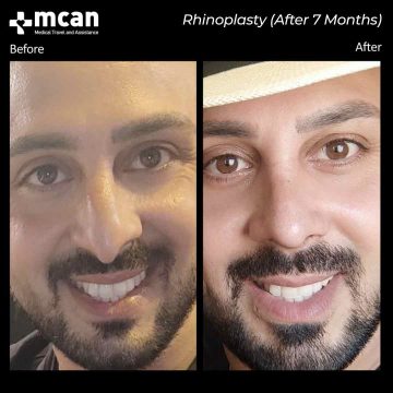 Rhinoplasty surgery before and after 4